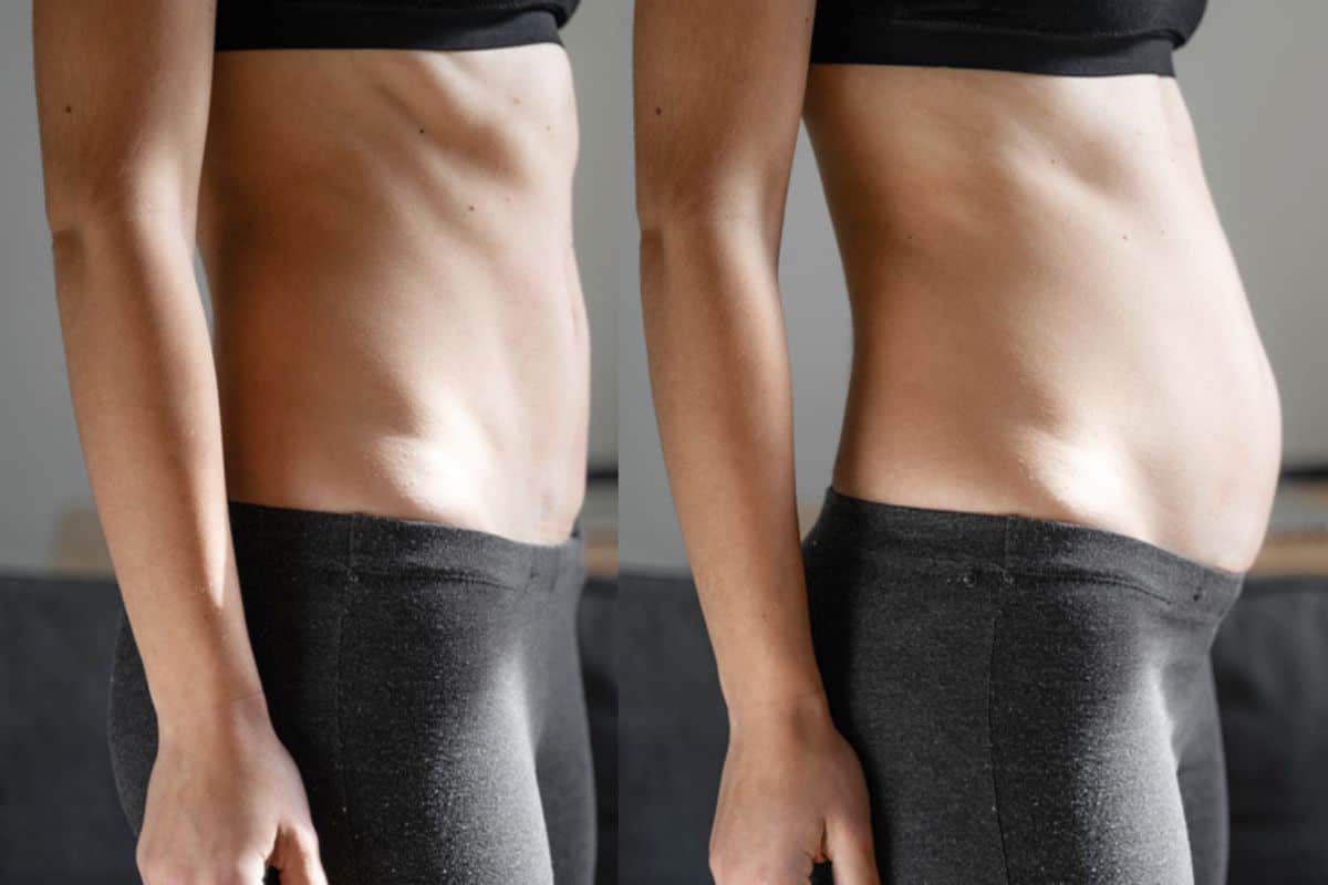 How long does diastasis recti take to improve Petersfield?