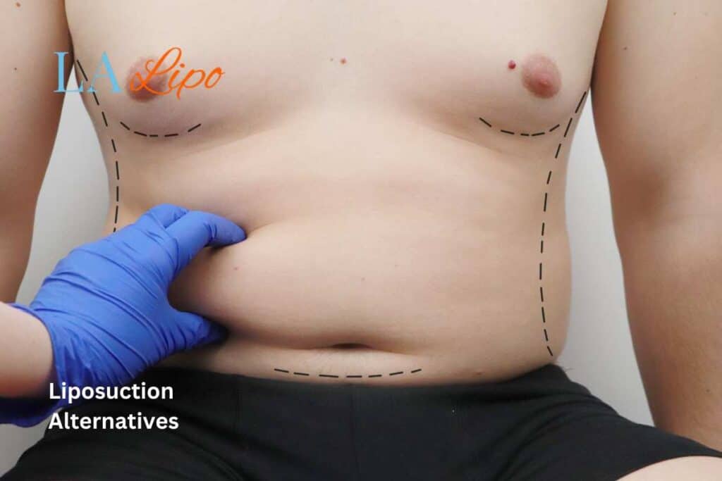 liposuction