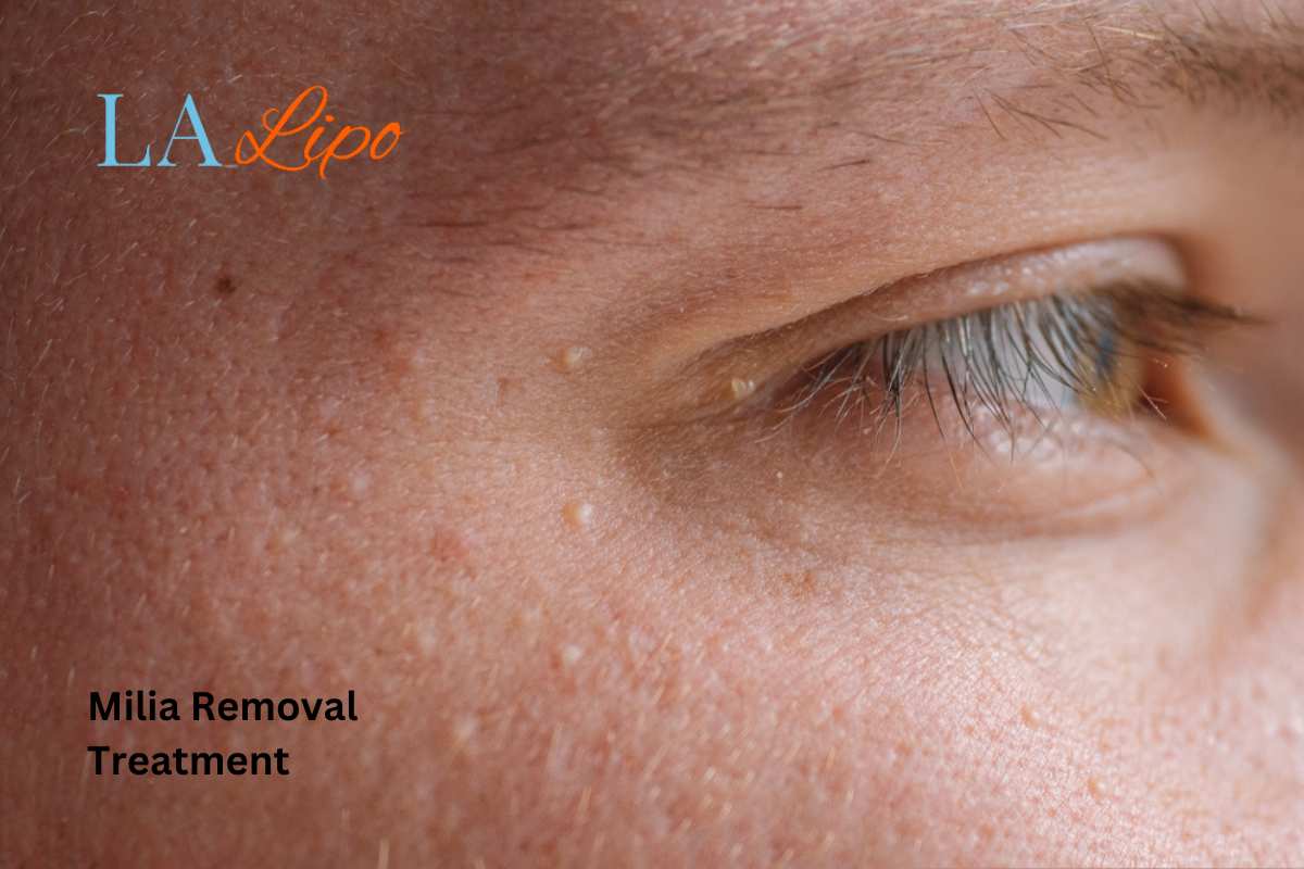 Cryopen Milia Removal: Is It the Easiest and Safest Option Petersfield?