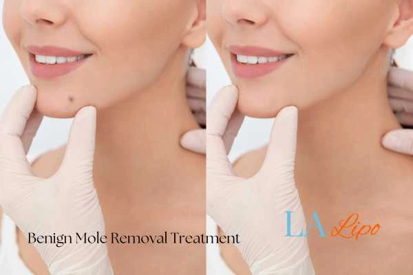 woman's before and after mole removal Petersfield results