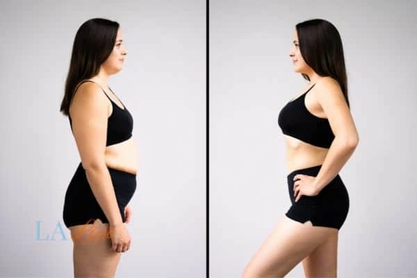 image of woman before and after results of LA-EMS Body Sculpting Petersfield to help treat Diastasis recti