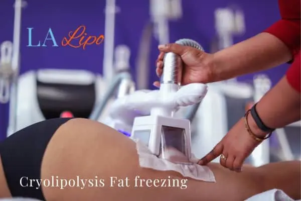 women getting fat freezing Petersfield