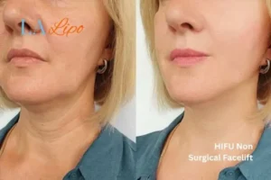 hi-fu for wrinkles Petersfield before and after results