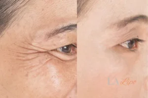 Before and after results of woman - HI-fu wrinkles reduction treatment Petersfield
