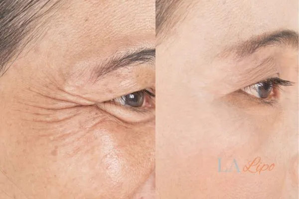 Before and after results of woman - HI-fu wrinkles reduction treatment Petersfield