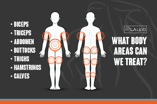 Graphic to show areas you can have LA-EMS Body Sculpting Petersfield treatment.