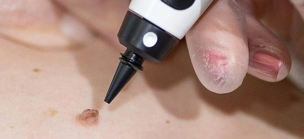 skin tag removal using cryopen Petersfield