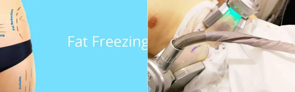 Fat freezing Petersfield on multiple areas of the body