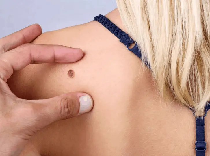 woman having mole removal Petersfield consultation before treatment.