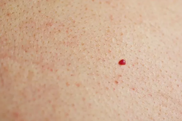 close up of a cherry angioma Petersfield