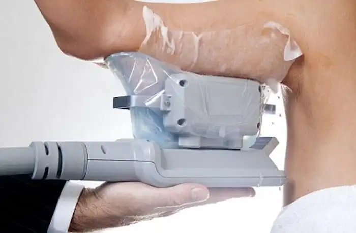 Picture of fat freezing Petersfield on the upper arms.