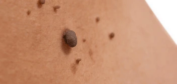 image of a skin tag Petersfield
