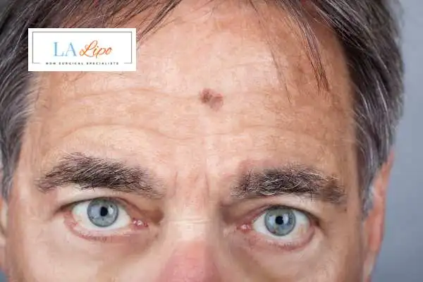 Solar Lentigo Removal Petersfield image of man with mark on his forehead
