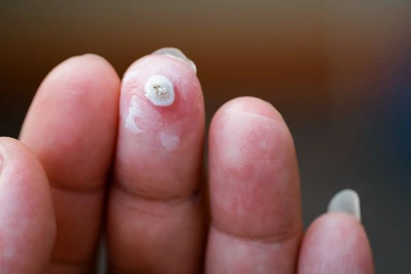 wart on person finger - cryotherapy to treat from LA LIPO Petersfield