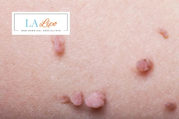 Does cryopen skin tag removal Petersfield hurt? Find out now call our team today!