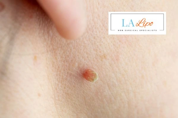 Book skin tag removal Petersfield today speak to our team now!