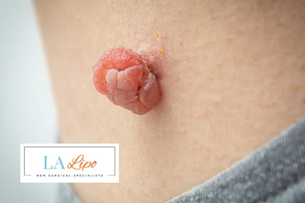 Interested in skin tag removal Petersfield? Concerned about the pain? Find out more today!