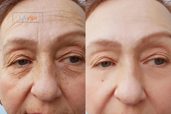 The powerful benefits of Morpheus8 Treatment Petersfield - Call Our team today!