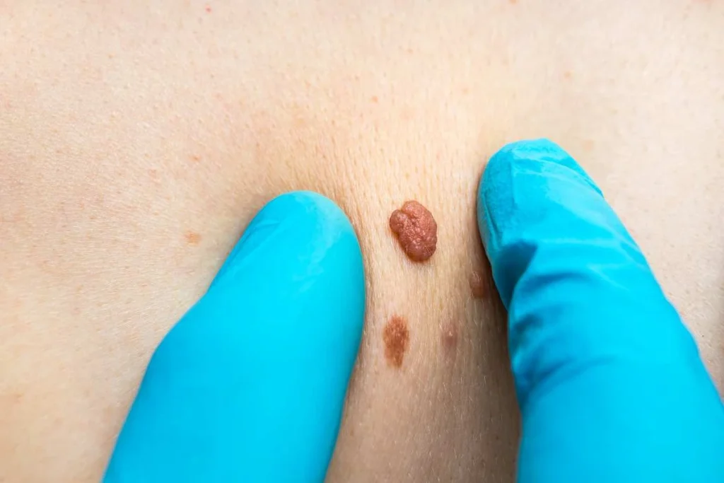 LA LIPO Cryopen Lesion Removal Prices Petersfield