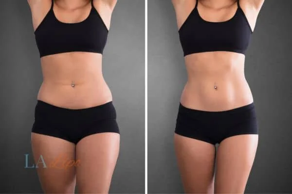 before and after results of non-surgical treatment to help a woman's body image and mental health Petersfield