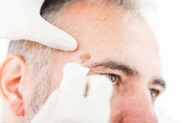 Age spots and elderly people Petersfield what is the link?