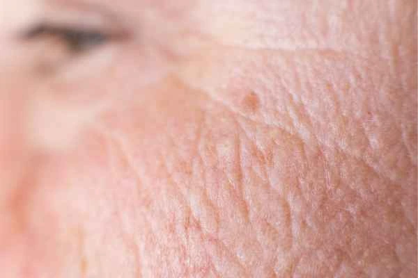 close up picture of a woman's face showing an age spot Petersfield