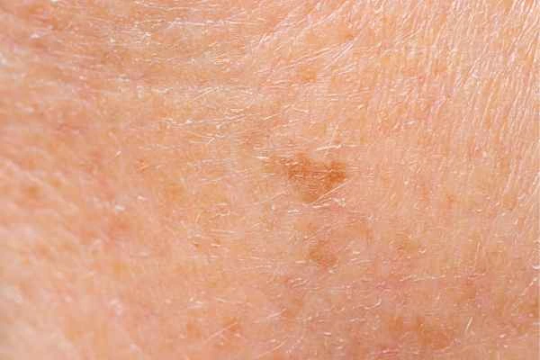 close up picture of age spots Petersfield