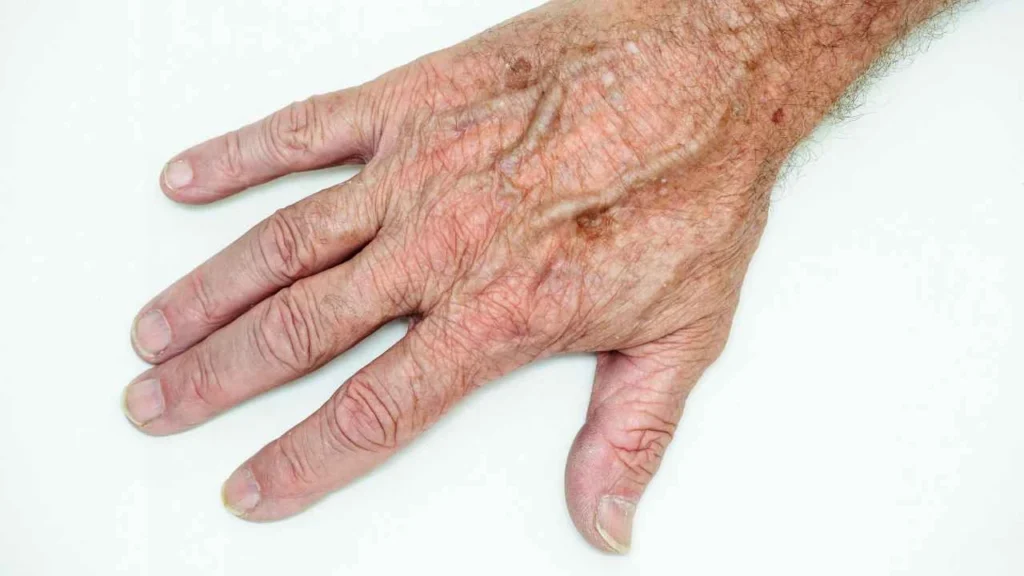 Male hand showing age spot Petersfield