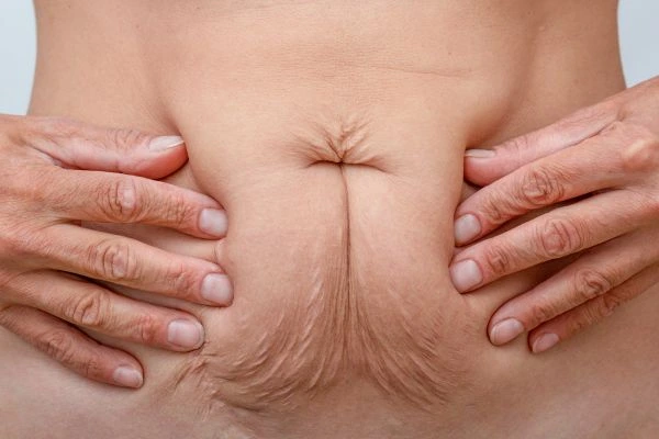 Should I Combine Diastasis Recti Treatment with Body Contouring for Better Results Petersfield?