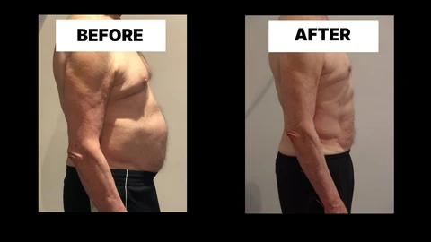What Symptoms Can Diastasis Recti Cause in Men? Weak Core, Back Pain and Poor Posture Petersfield